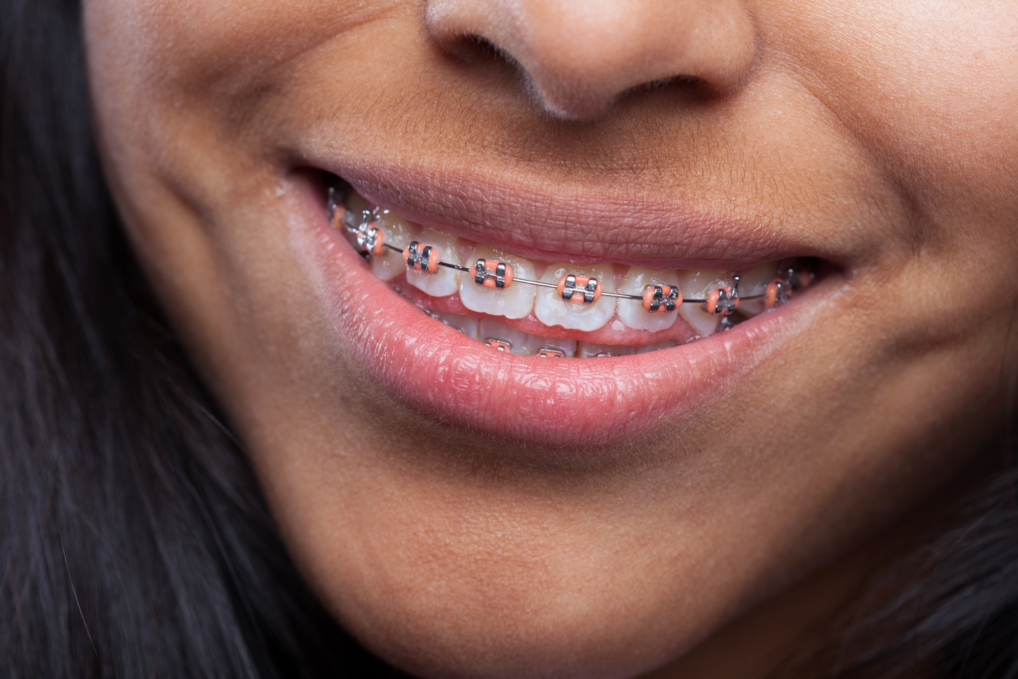 Teeth Bracing