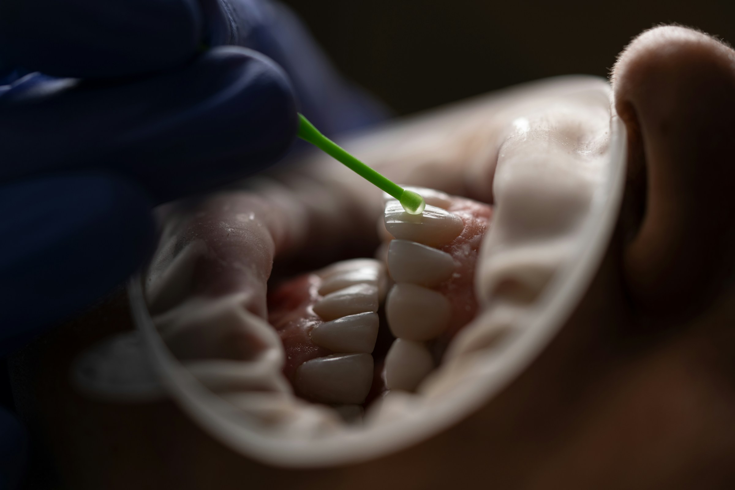 Teeth Scaling